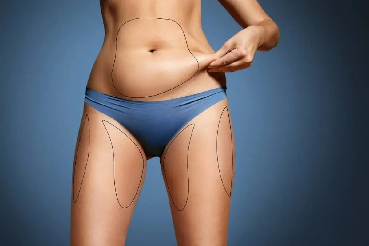 Microlipo: Άμεση και Ασφαλής Λύση για Τοπικό Πάχος στην κοιλιά και τους μηρούς με αναγραφή περιοχών