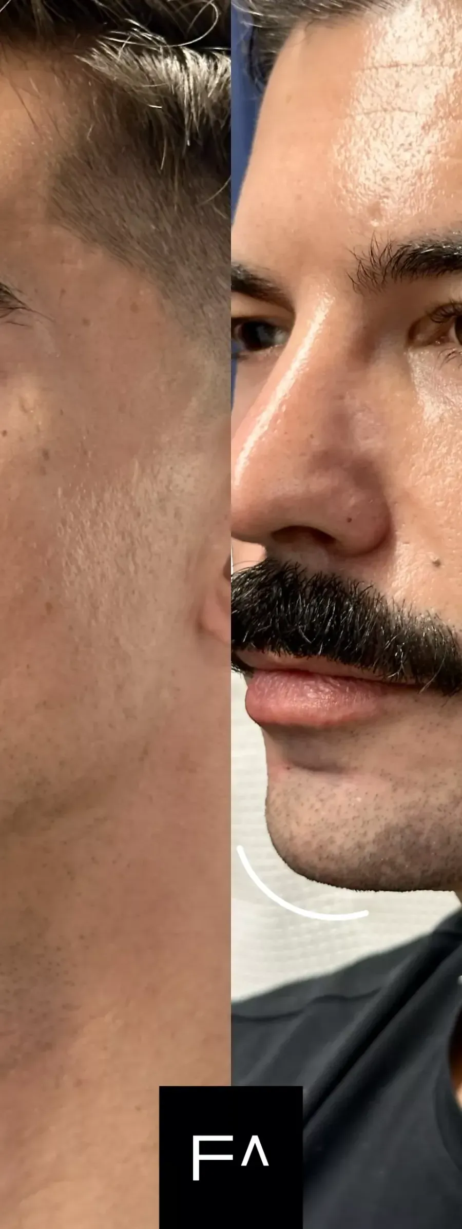 Injectable Hyaluronic Acid for facial contouring, before and after.