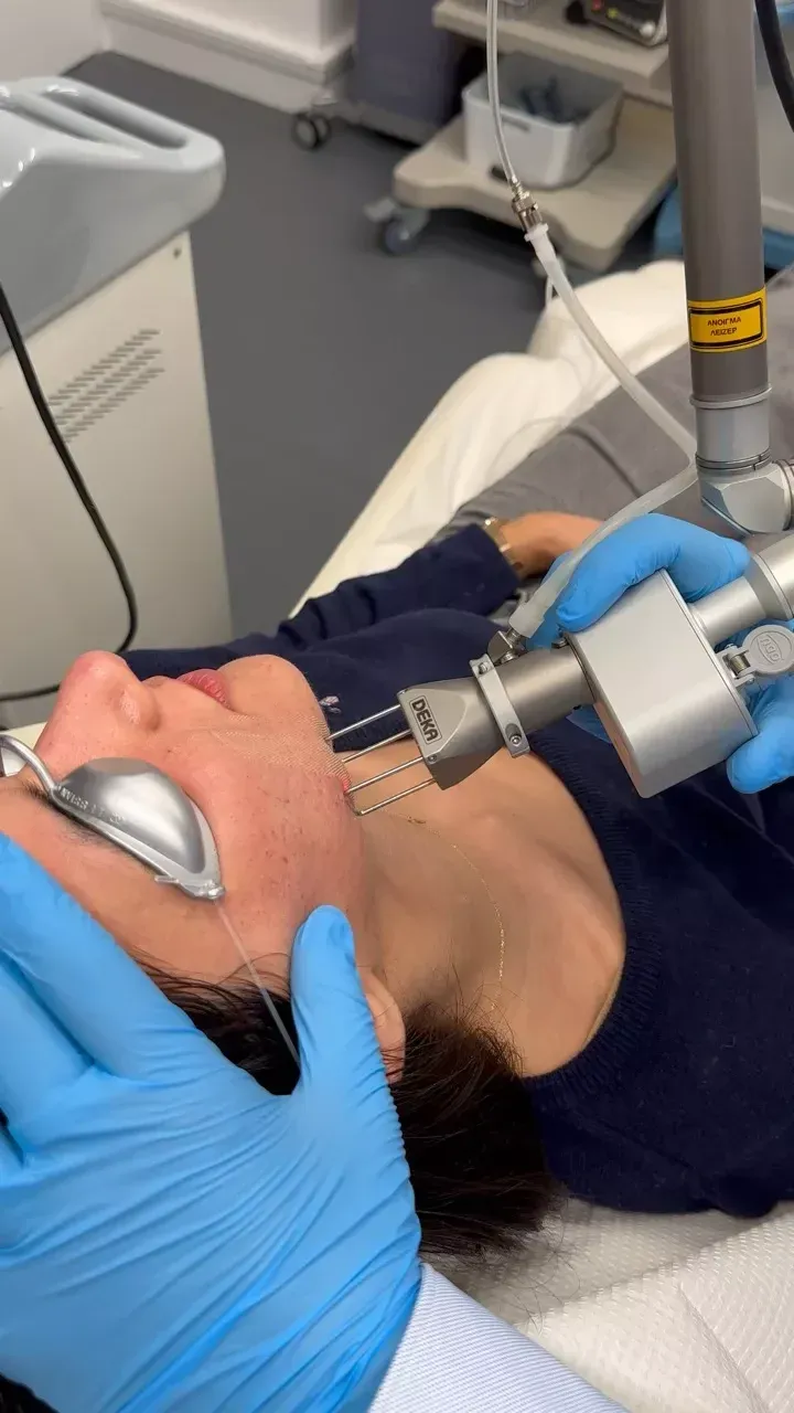 Fractional Laser σε πρόσωπο γυναίκας, με γάντια και προστατευτικά γυαλιά.