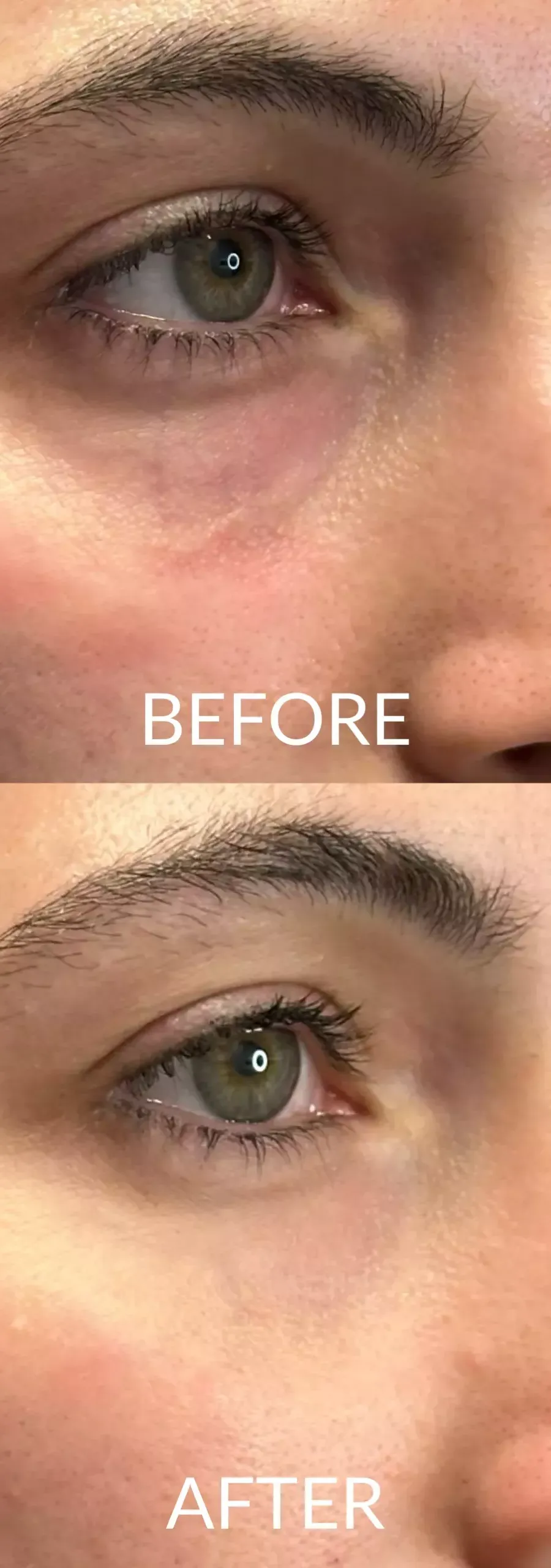 Hyaluronic Acid Under Eyes Treatment: Cost, Before and After