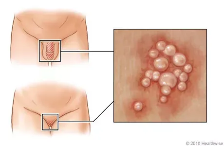 Genital Herpes: Symptoms, Transmission & Treatment