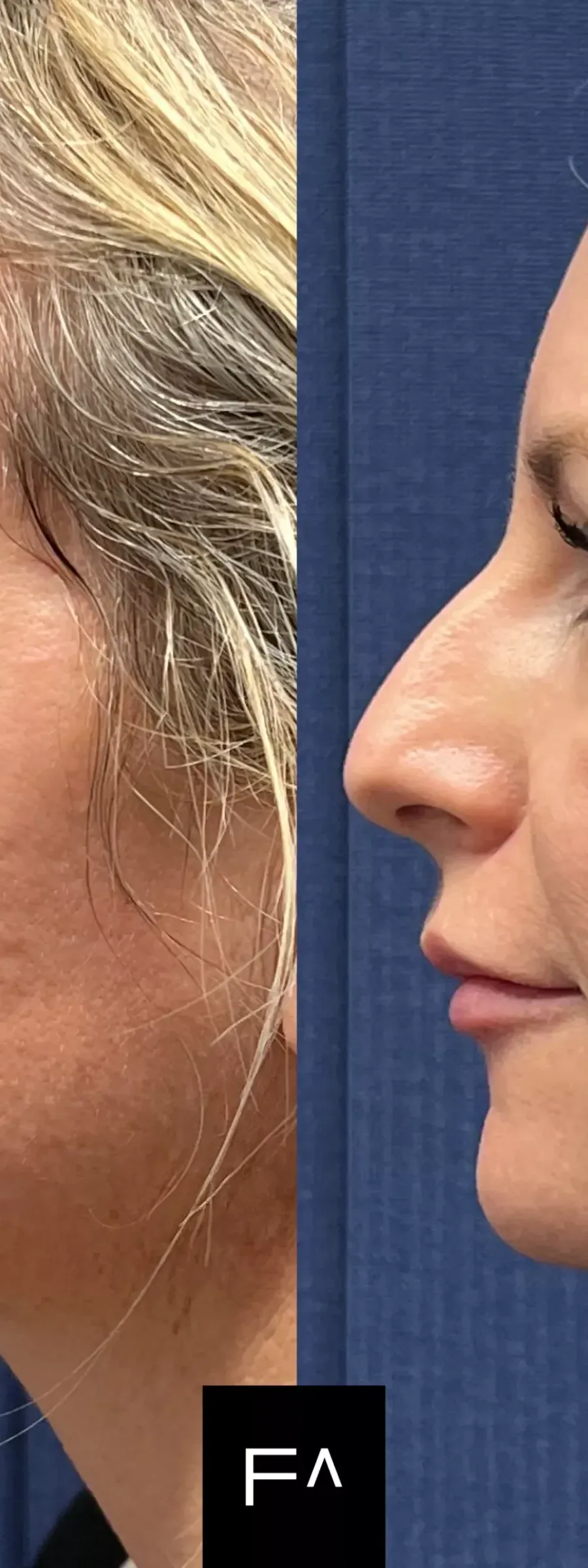 before and after Beautification: What it is, Procedure & Facial Results in the side profile