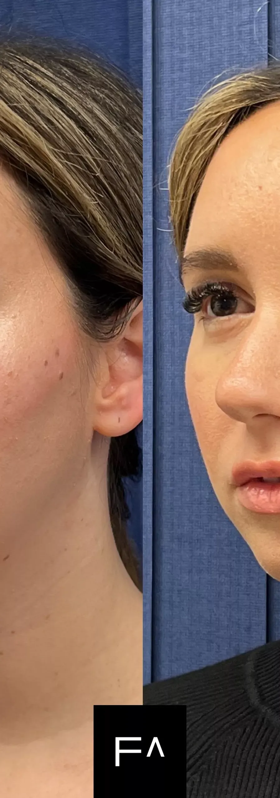 Hyaluronic Acid or Botox: Which Treatment to Choose?
