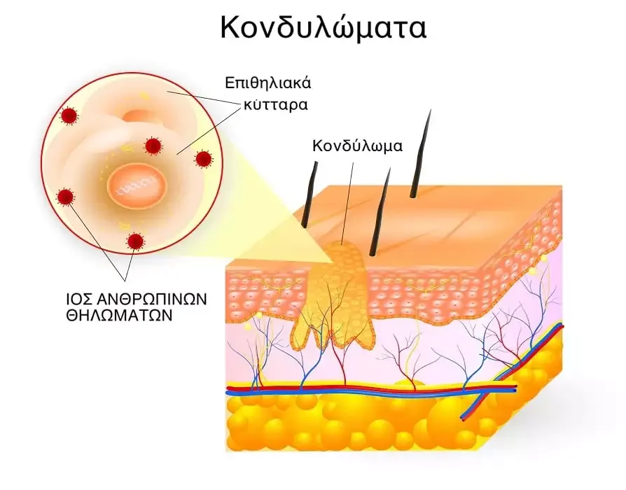 κονδυλώματα hpv