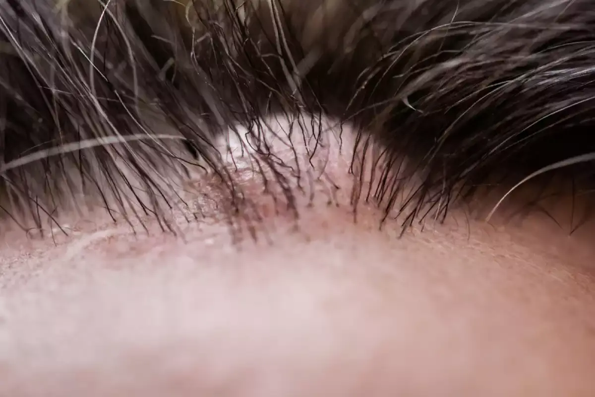 Sebaceous Cyst