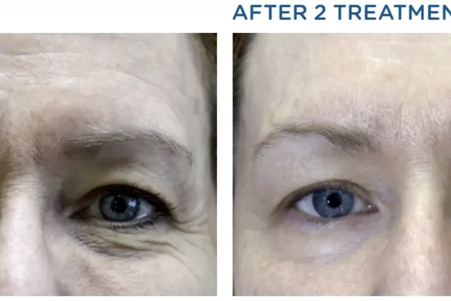 πριν και μετά Notox Exilis στο μέτωπο και στα μάτια