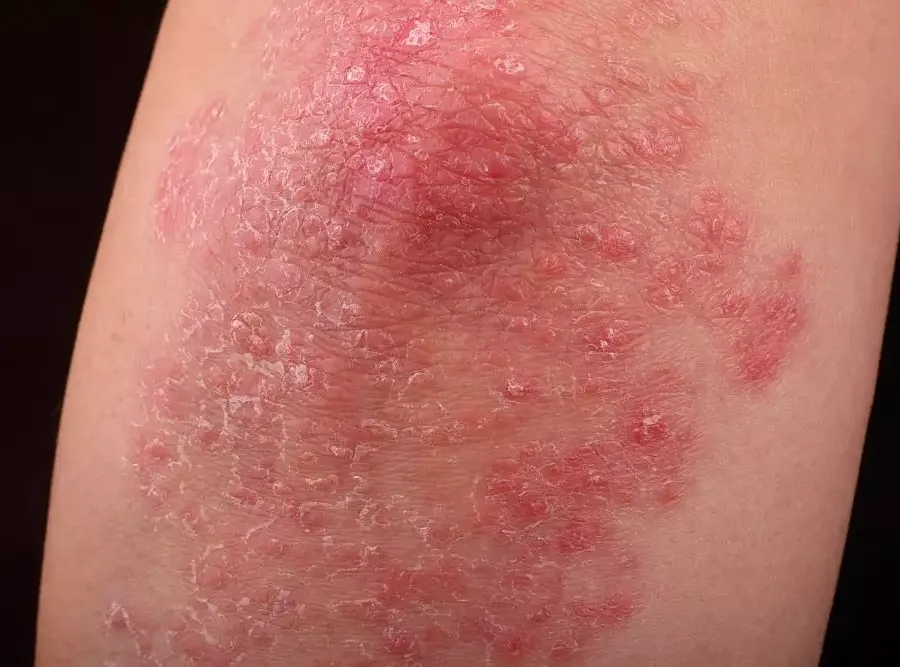 Psoriasis: Early Stage, Pictures, Symptoms, and Treatment – Psoriasis: Early Stage, showing red patches with silvery scales on a p