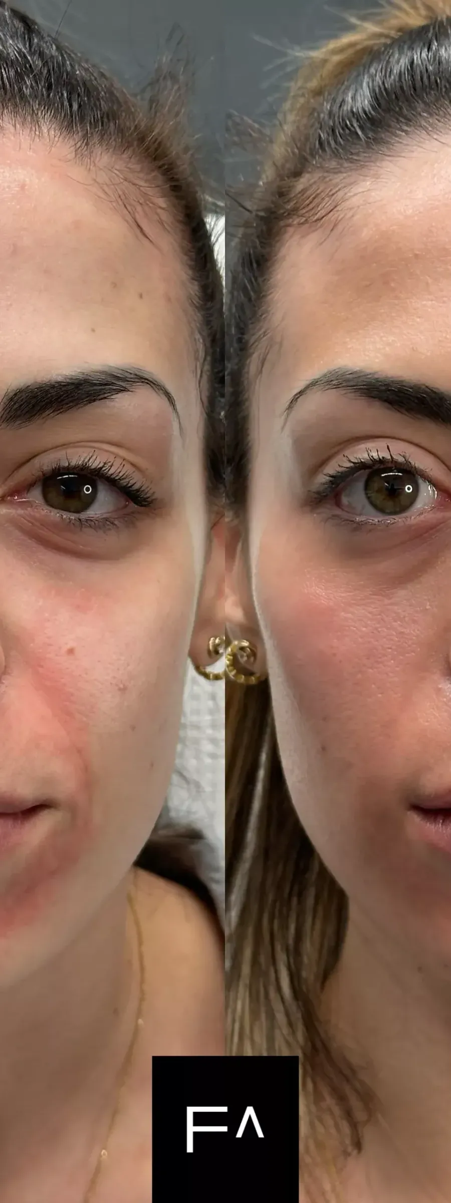 before and after Beautification: What it is, Procedure & Facial Results in the mouth area
