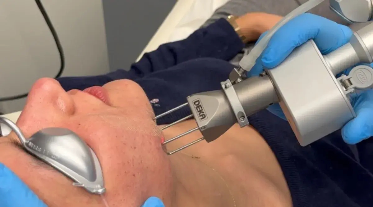 Υπέρ και Κατά του Fractional Laser: Τι Πρέπει να Γνωρίζεις στην περιοχή του λαιμού
