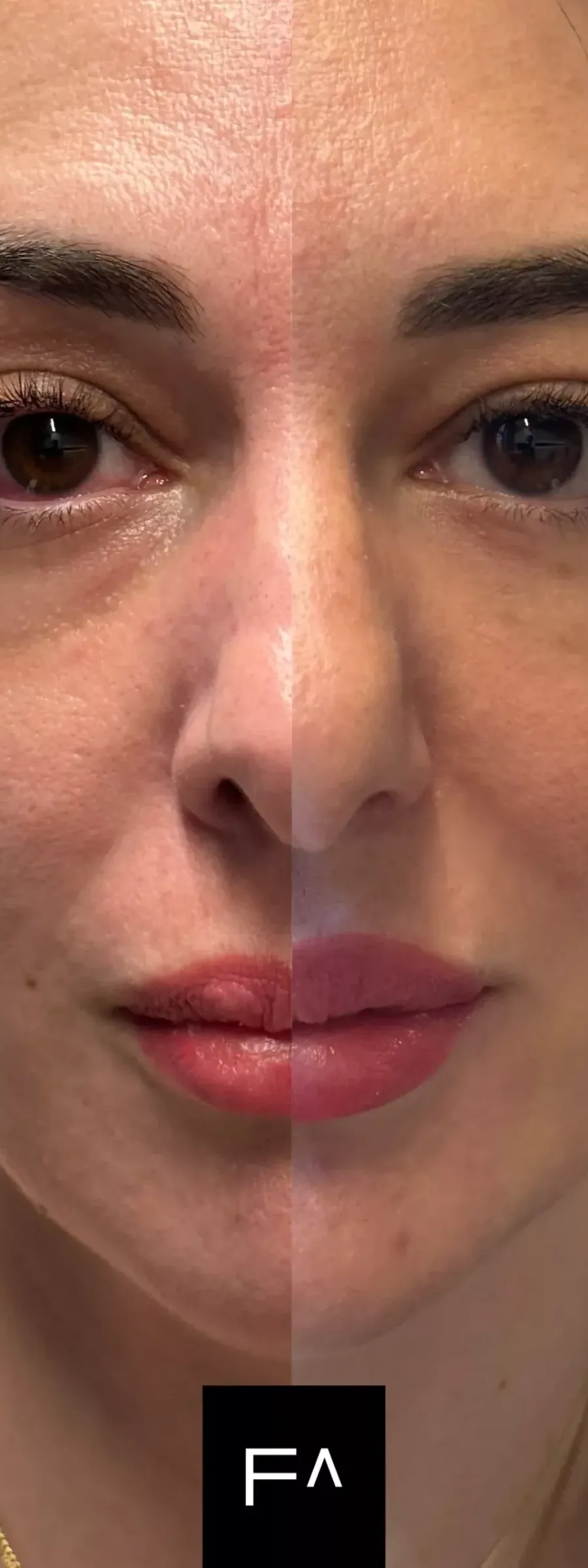 Before and after: Hyaluronic Acid for improvement in the woman's eyes and lips.