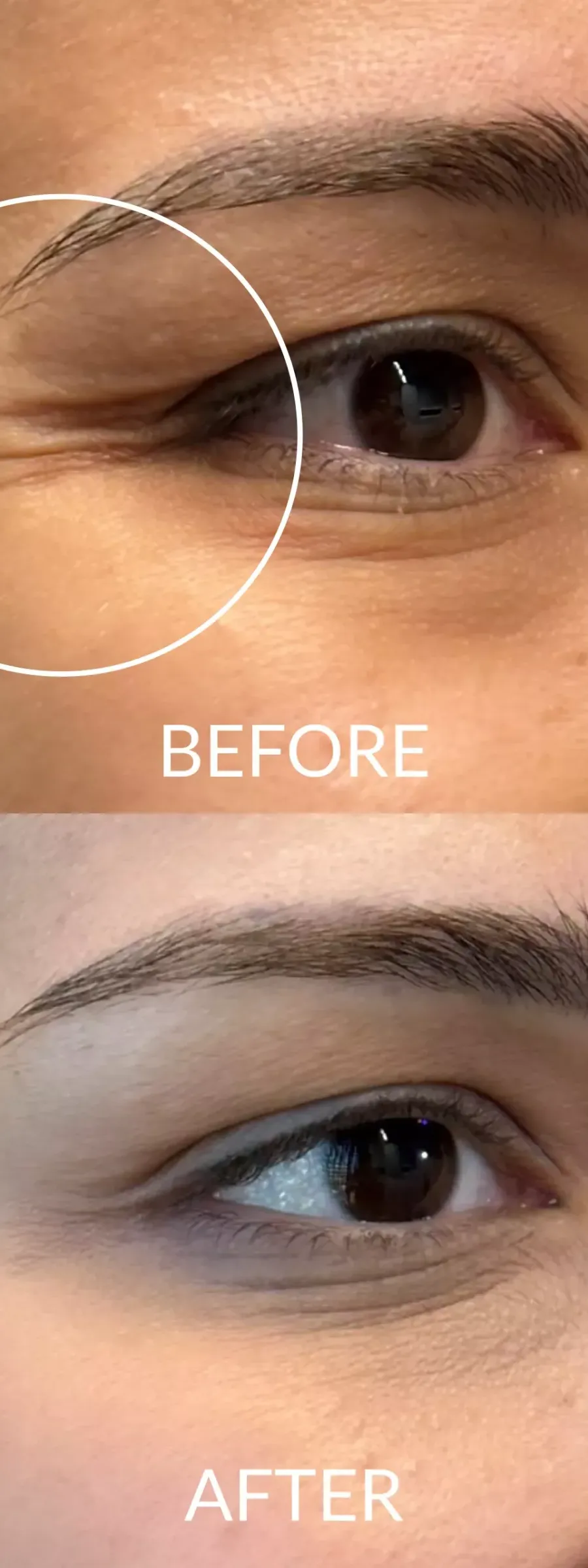 Botox πριν και μετά, μείωση ρυτίδων έκφρασης στα μάτια (πόδι της χήνας).