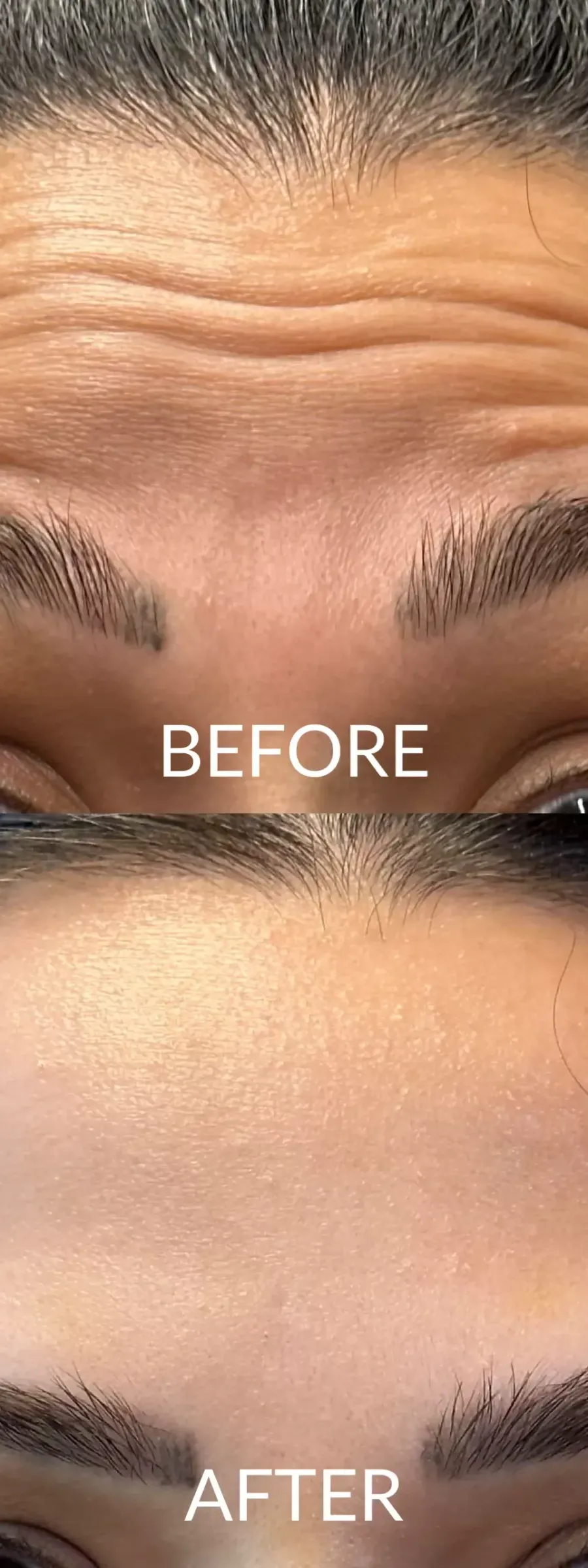 Αποτελέσματα Botox πριν και μετά σε γυναίκα με ορατή μείωση ρυτίδων στο μέτωπο.