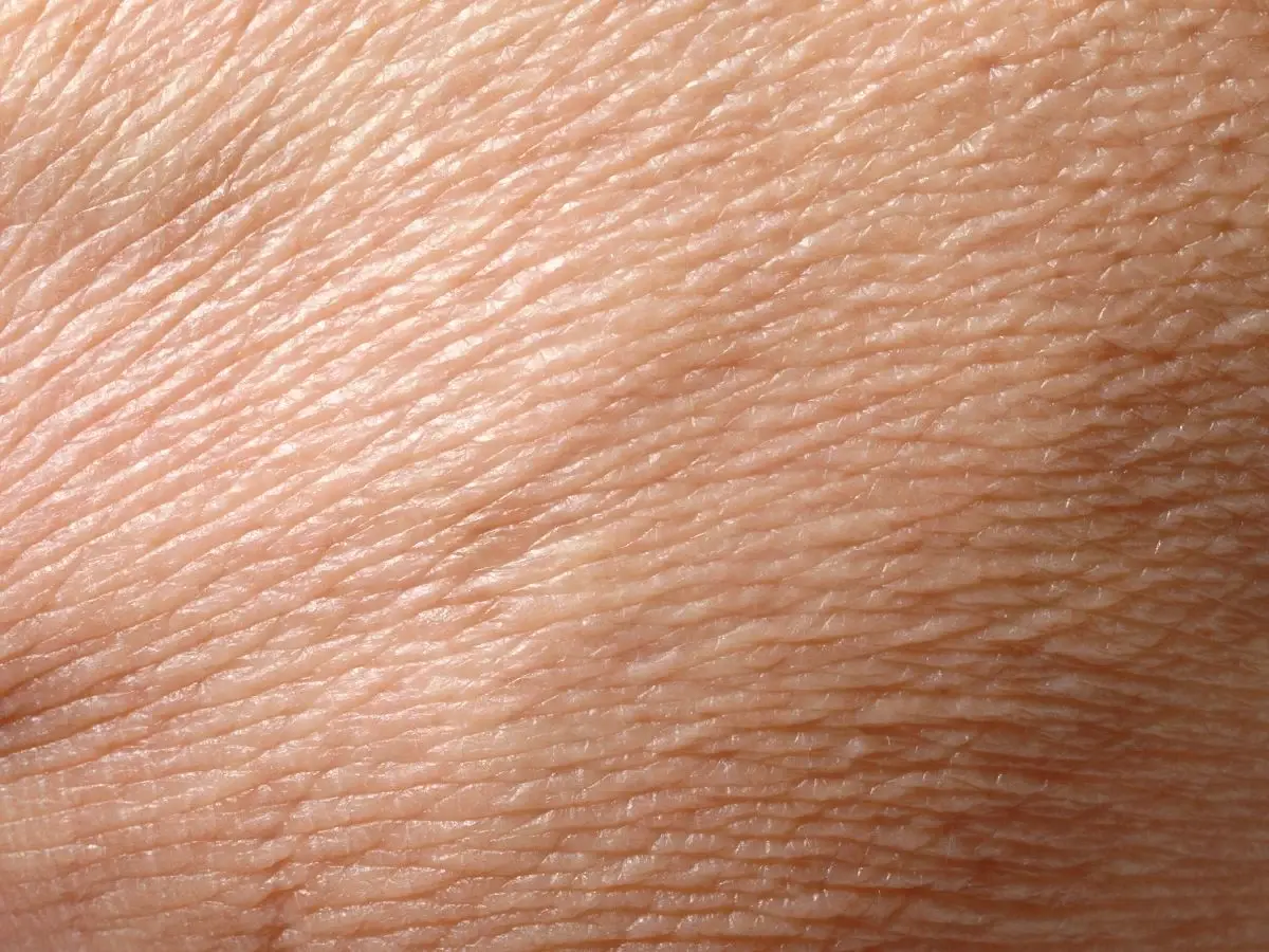 Dehydrated Skin