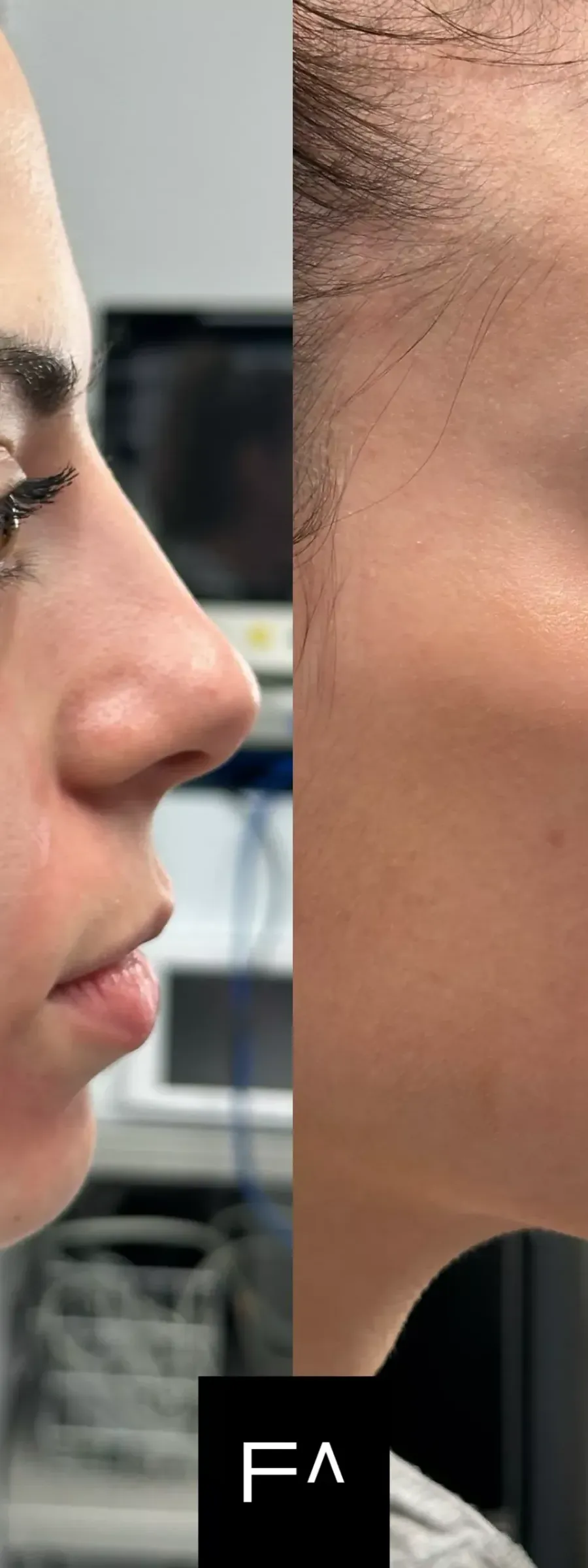 before and after Beautification: What it is, Procedure & Facial Results on the side of the face
