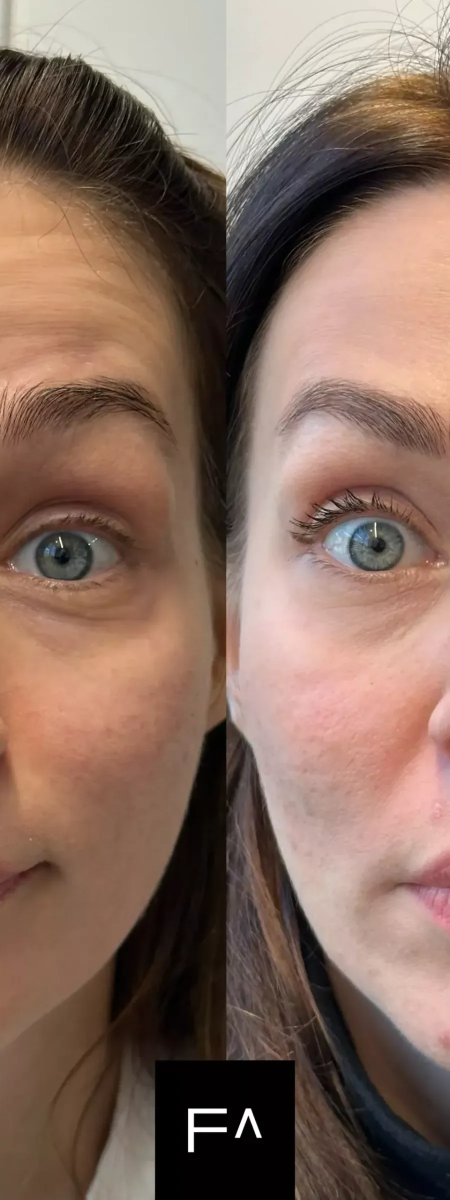 Botox αποτελεσμάτων σε γυναίκα, πριν και μετά τη θεραπεία, με λιγότερες ρυτίδες στο μέτωπο.