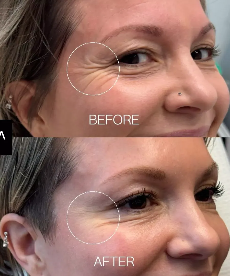Τι απαγορεύεται μετά το botox