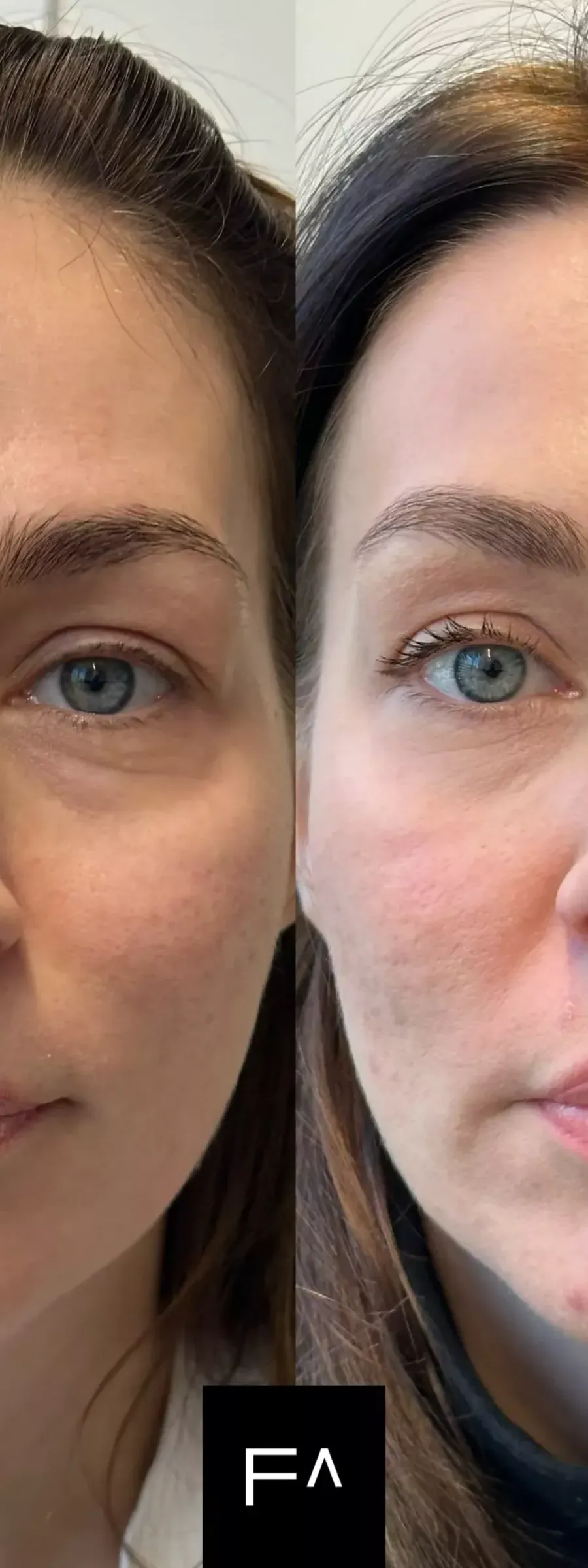 Botox πριν και μετά, με μείωση λεπτών γραμμών και βελτίωση της υφής του δέρματος.