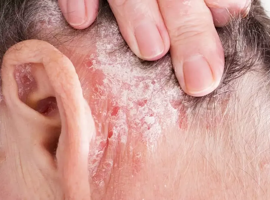 Psoriasis: Early Stage, Pictures, Symptoms, and Treatment – Psoriasis: Early Stage, showing red patches with silvery scales behind