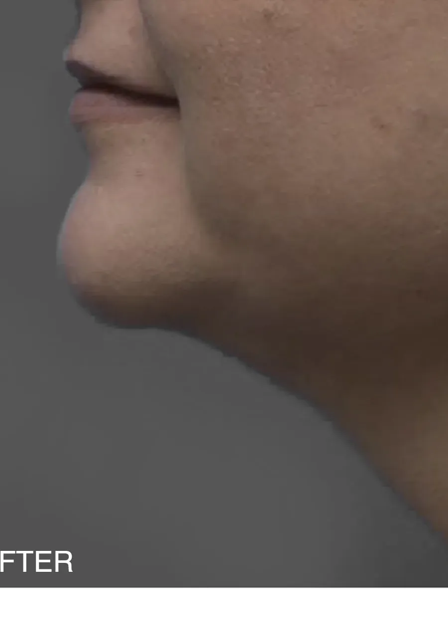 Microlipo: Η mini λιποαναρρόφηση στο πηγούνι, μετά τη θεραπεία αφαίρεσης λίπους