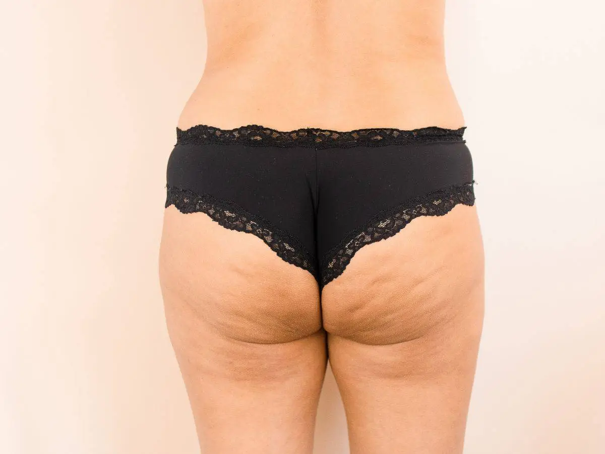 Buttocks Cellulite: How to Treat It