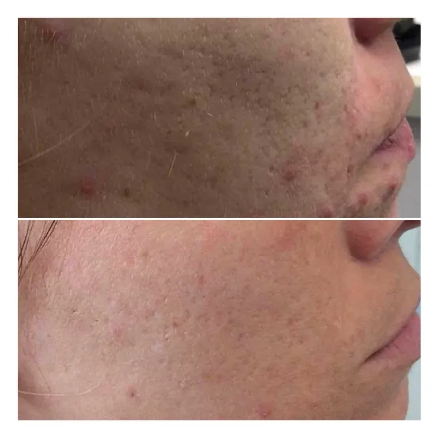 Fractional laser CO2 πρόσωπο αποτελέσματα