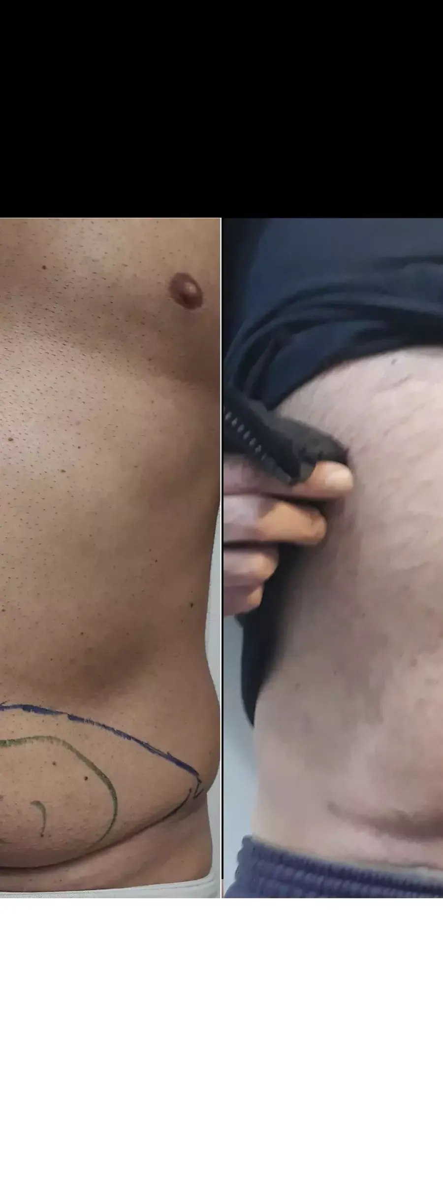 πριν και μετά Microlipo: Η mini λιποαναρρόφηση στην κοιλιά άνδρα