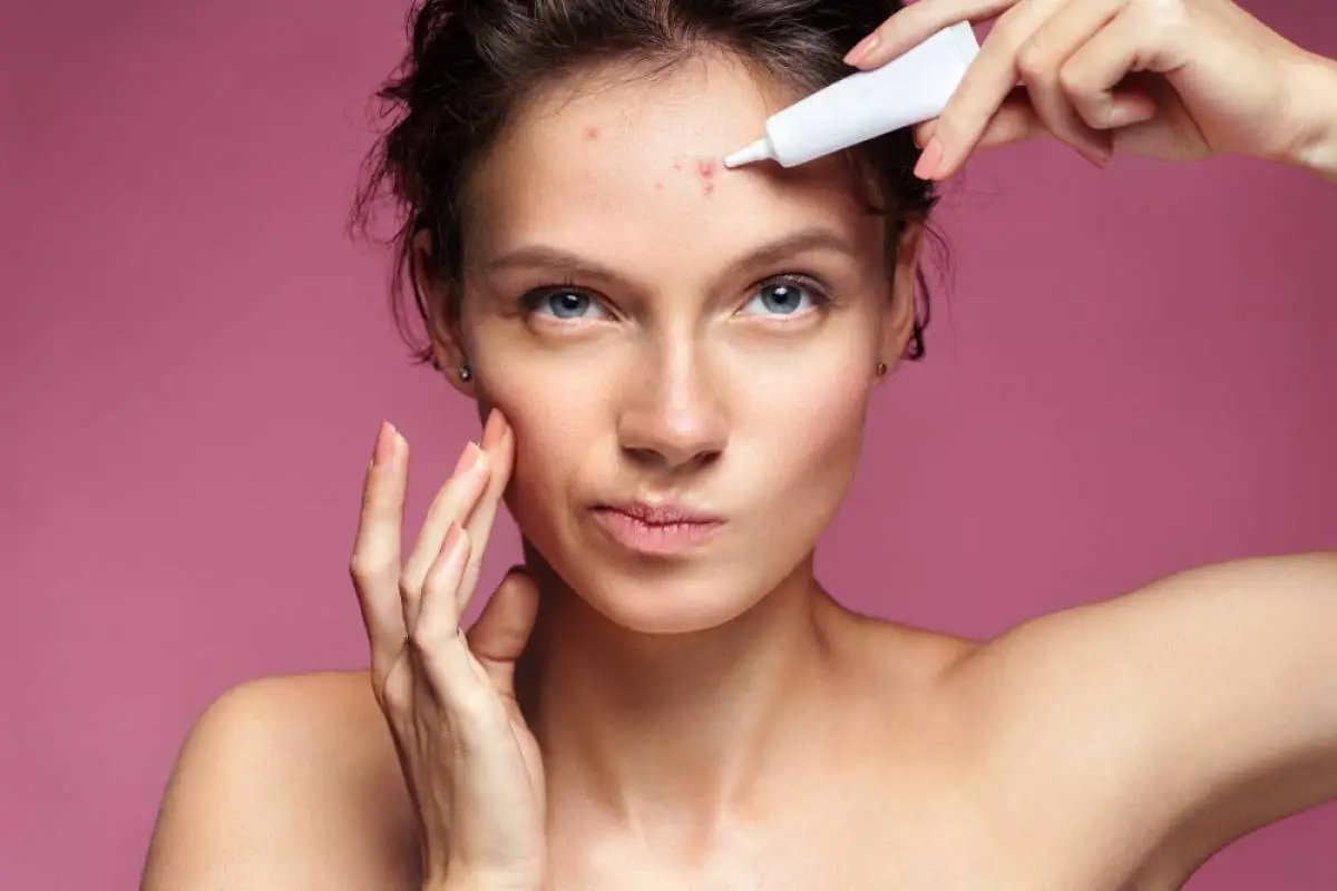 Acne and Treatment