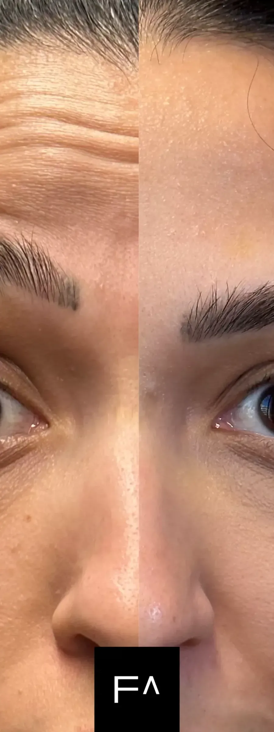 Αποτελέσματα Botox πριν και μετά σε γυναίκα με ορατή μείωση ρυτίδων στο μέτωπο.
