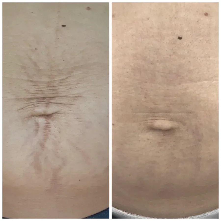 Fractional laser CO2 ραγάδες αποτελέσματα