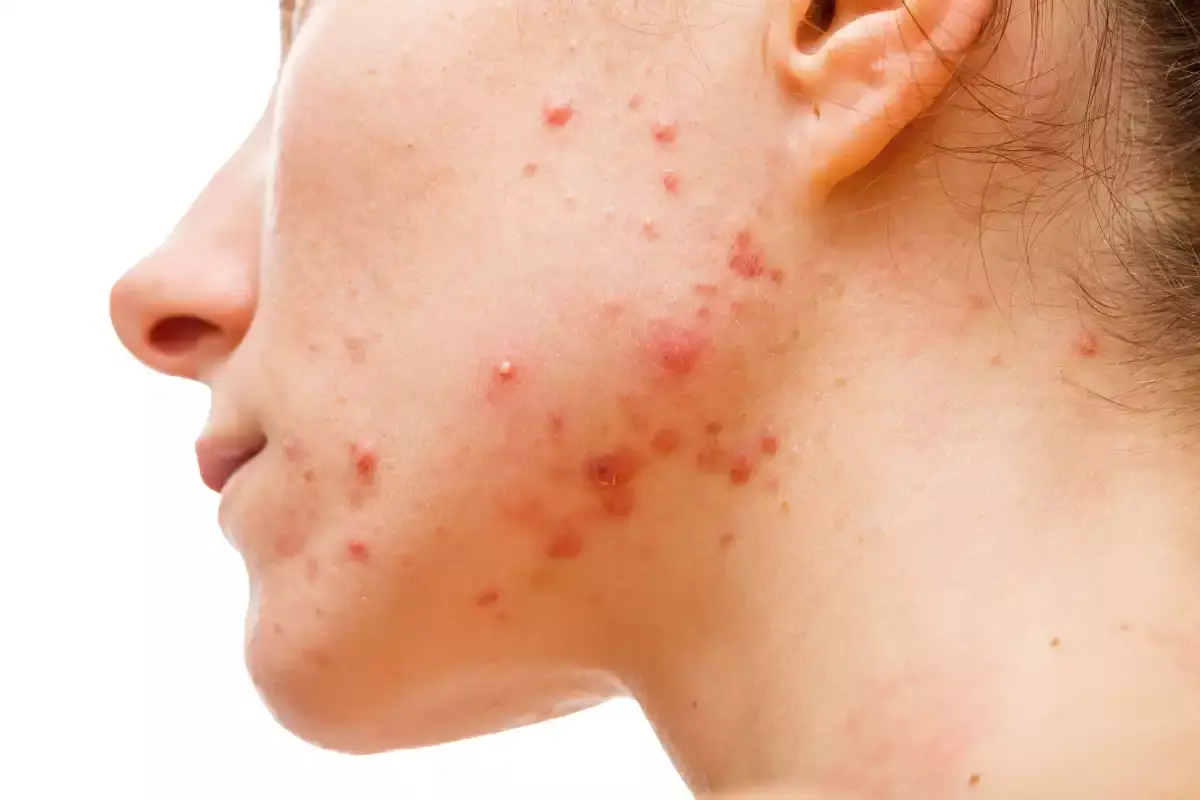 Acne Plus