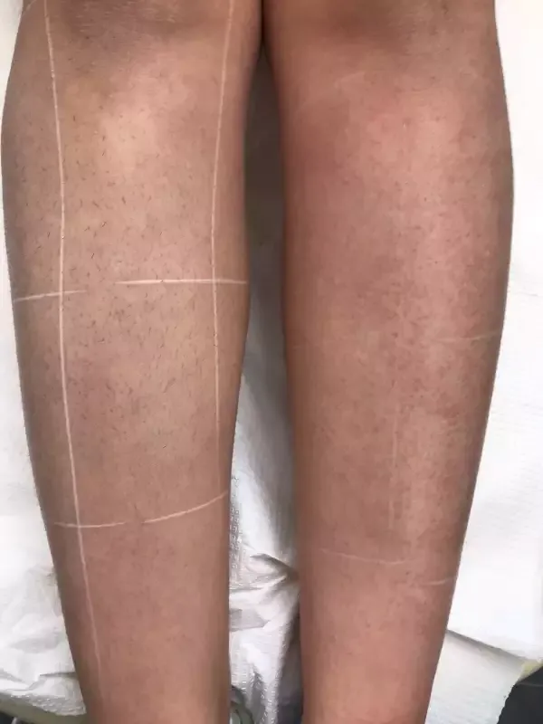 laser αποτρίχωση χέρια