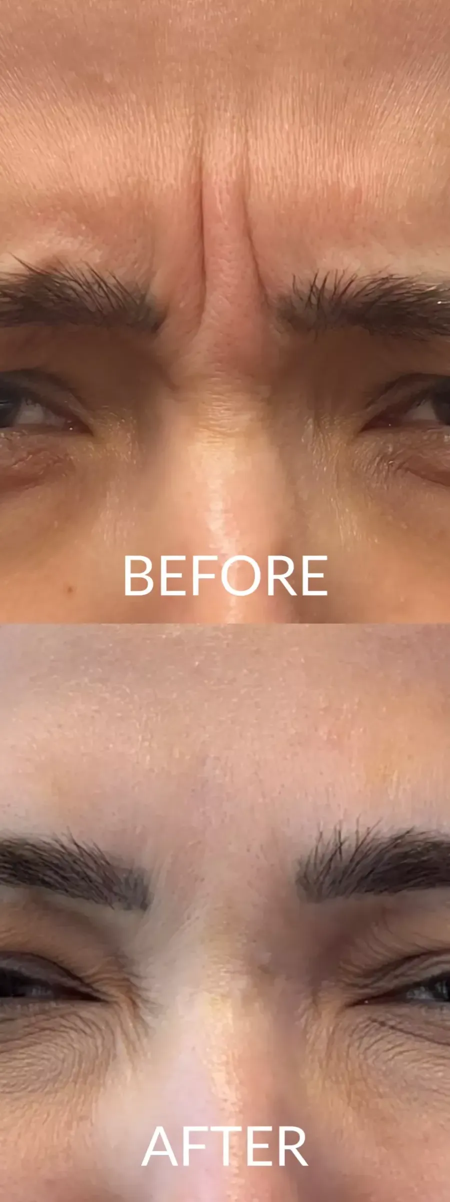 Αποτελέσματα Botox πριν και μετά σε γυναικείο πρόσωπο.