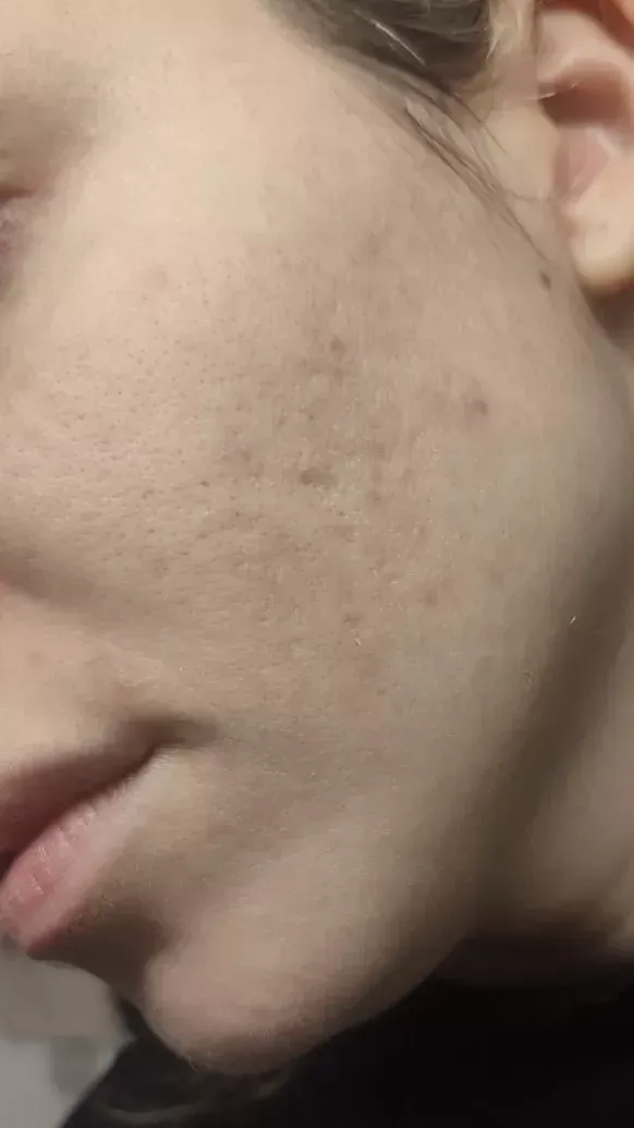 Acne Treatment: Θεραπεία αντιμετώπισης για τη Ροδόχρους Ακμή σε παρειά μετά τη θεραπεία