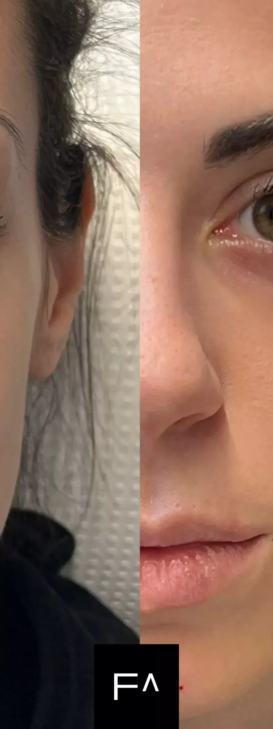 Before and after: Hyaluronic Acid in the cheekbones and under-eye area.