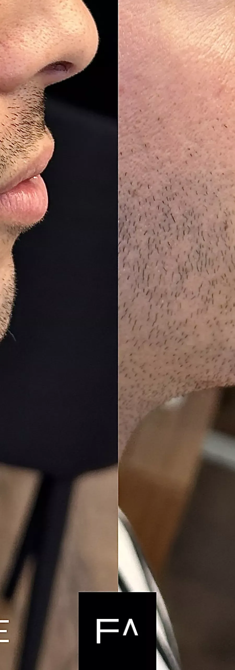 Hyaluronic Acid: Before and after application to a man's jaw in profile.