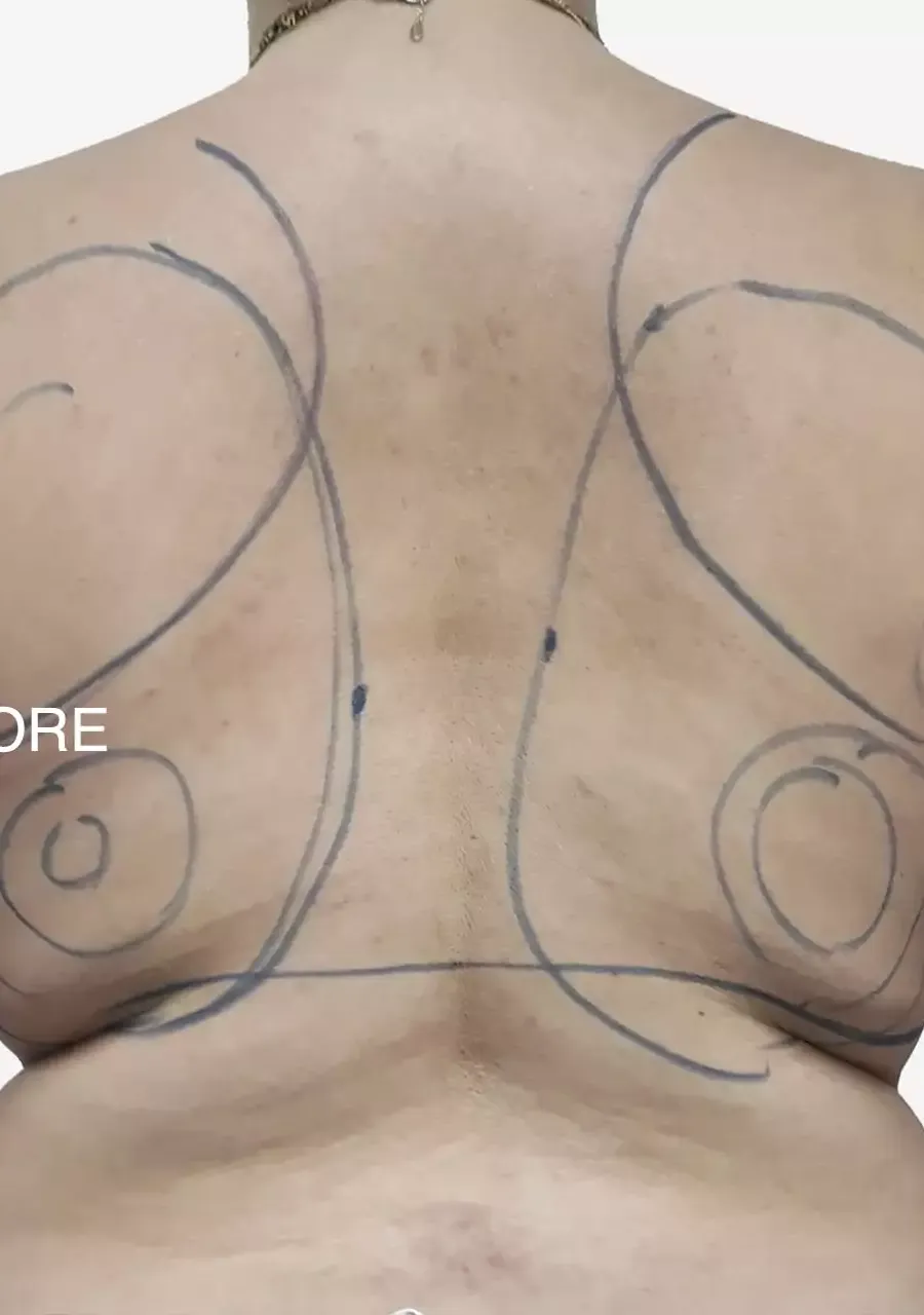 πριν Microlipo: Η mini λιποαναρρόφηση στην πλάτη με σημάνσεις για λιποαναρρόφηση