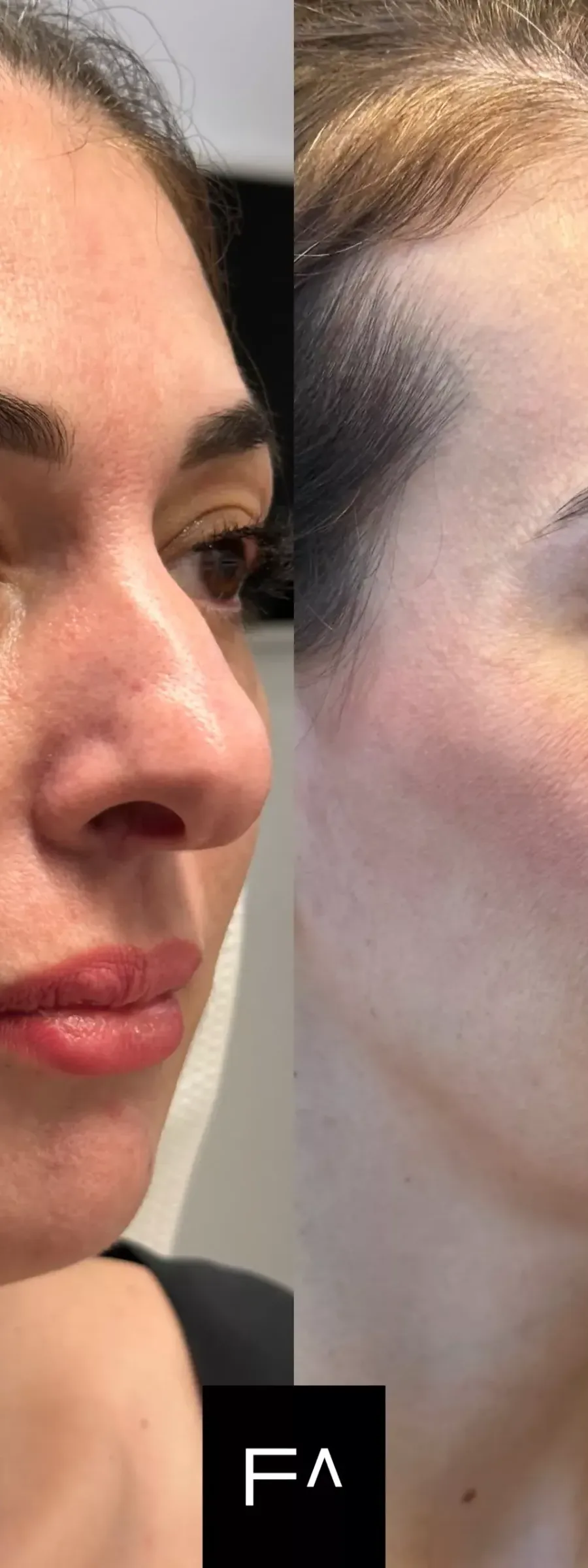 Hyaluronic Acid: Before and after facial application, with improved contour.