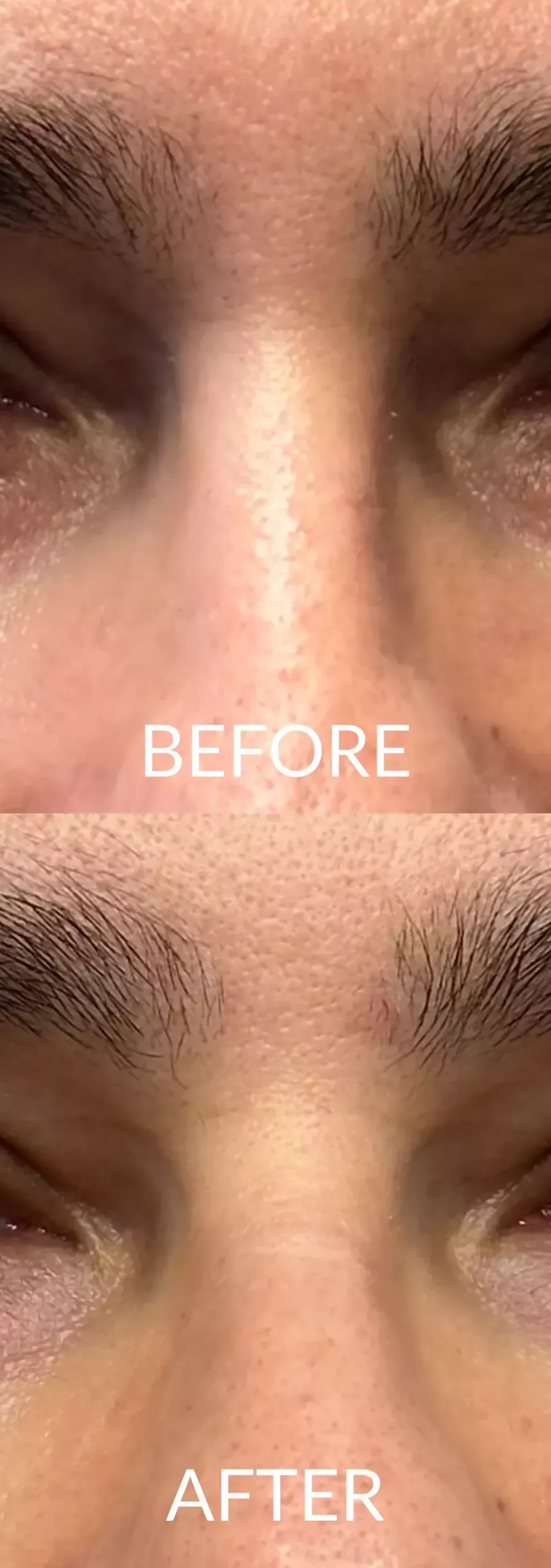 Hyaluronic Acid Under Eyes Treatment: Cost, Before and After