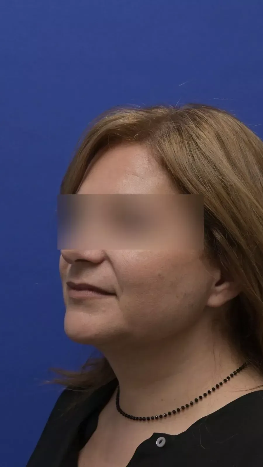 προγούλι γυναίκας σε προφίλ, πριν από αισθητική επέμβαση