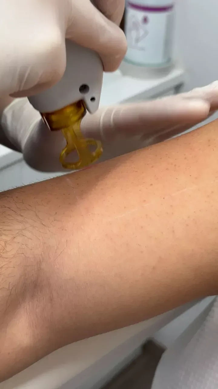 εφαρμογή laser αποτρίχωσης