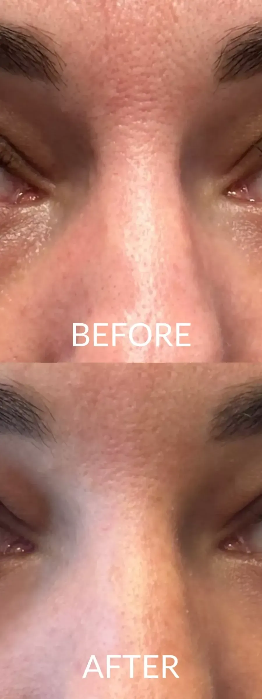 Hyaluronic Acid – Before and after application of Hyaluronic Acid in the eye area to reduce wrinkles.