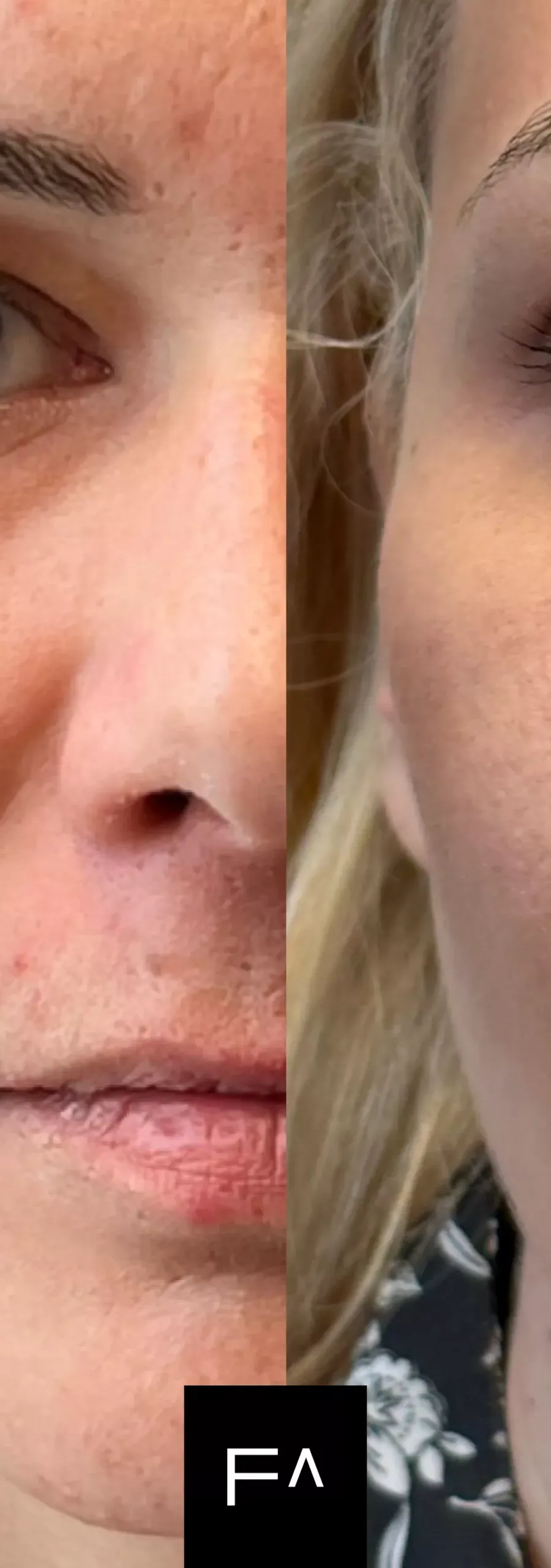 Hyaluronic Acid: Before and after results in a woman with improved skin texture.