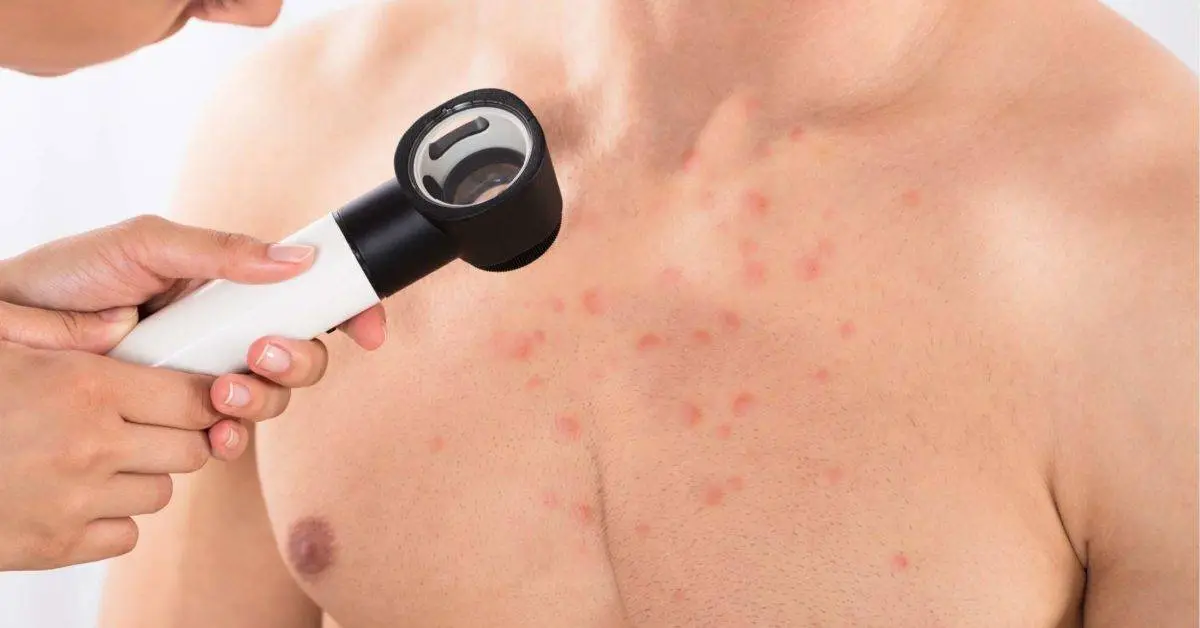 Folliculitis