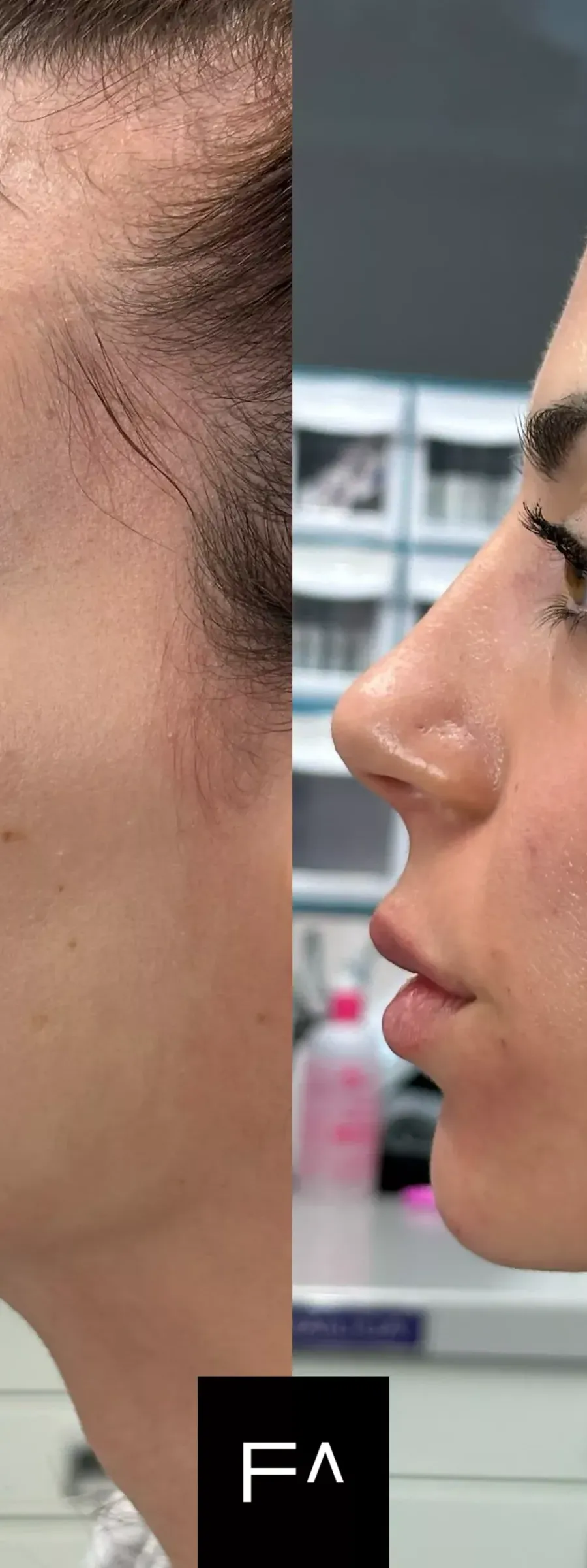 before and after Beautification: What it is, Procedure & Facial Results in the jaw area.