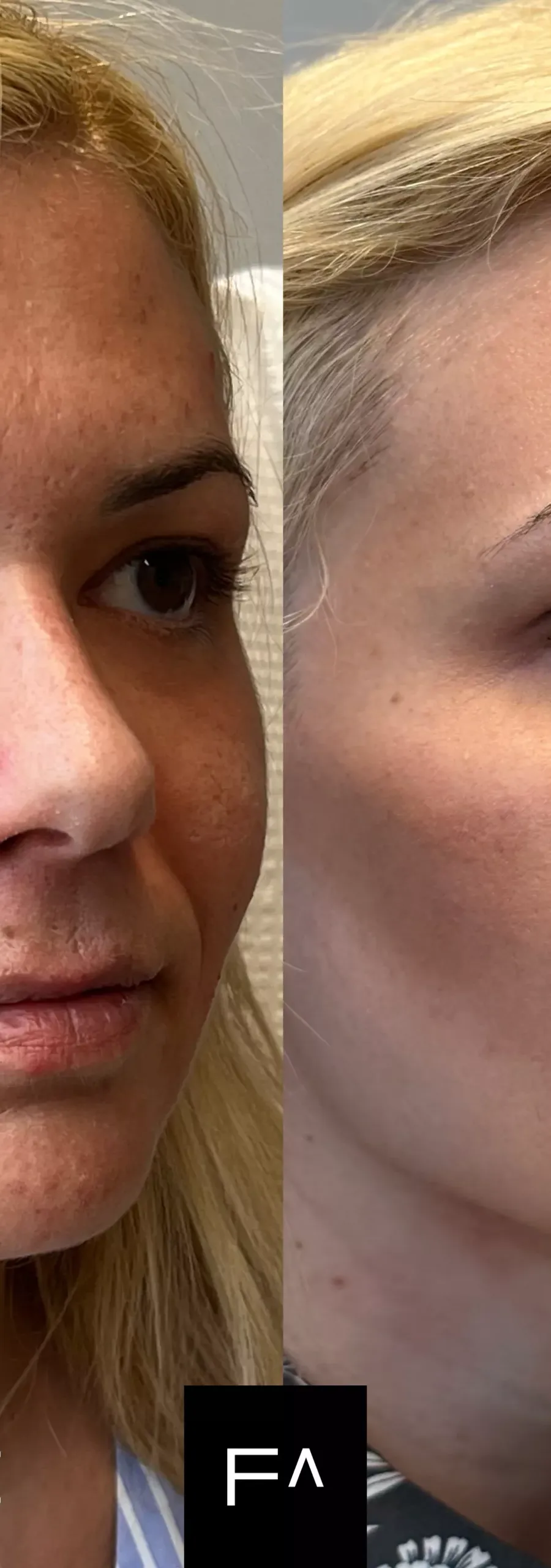 Hyaluronic Acid – Before and after, female face. On the left, the face has deeper wrinkles, on the right...