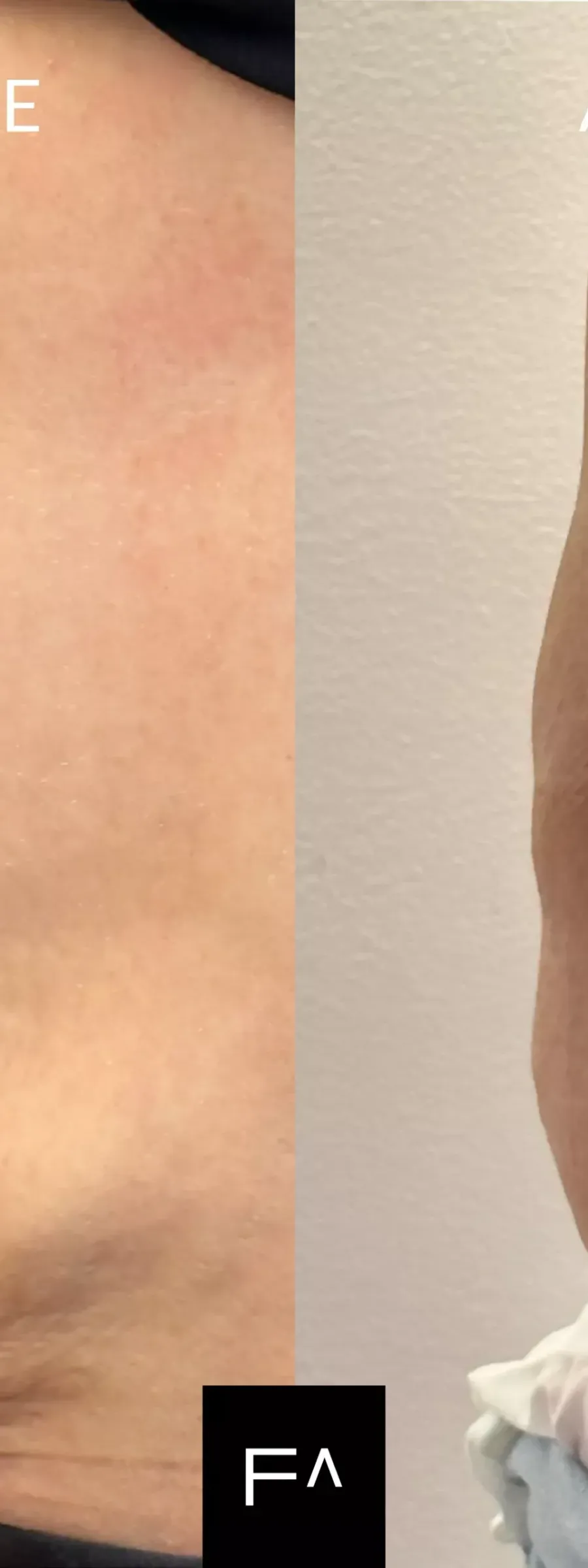 Exilis στην κοιλιά