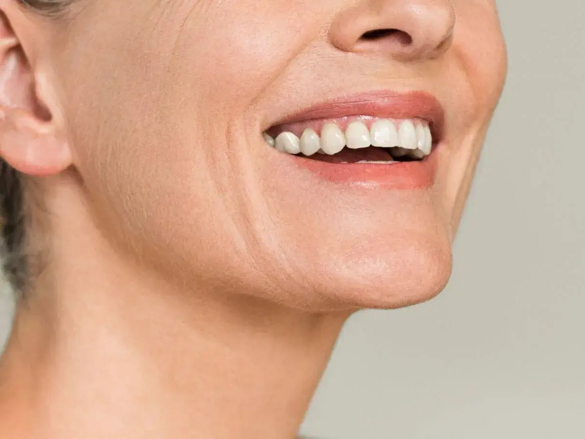 Woman with marionette lines, ready to use hyaluronic acid.