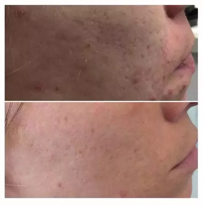Fractional Laser: What it is, Cost, Before and After