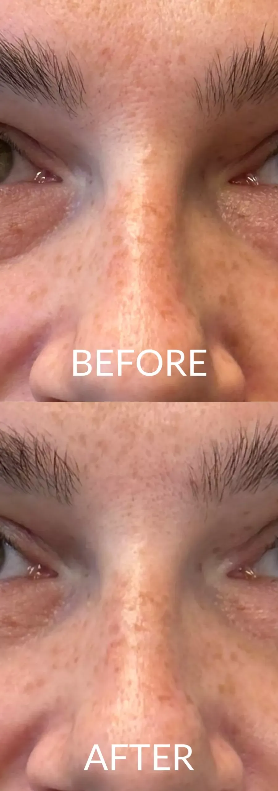 Hyaluronic Acid Under Eyes Treatment: Cost, Before and After