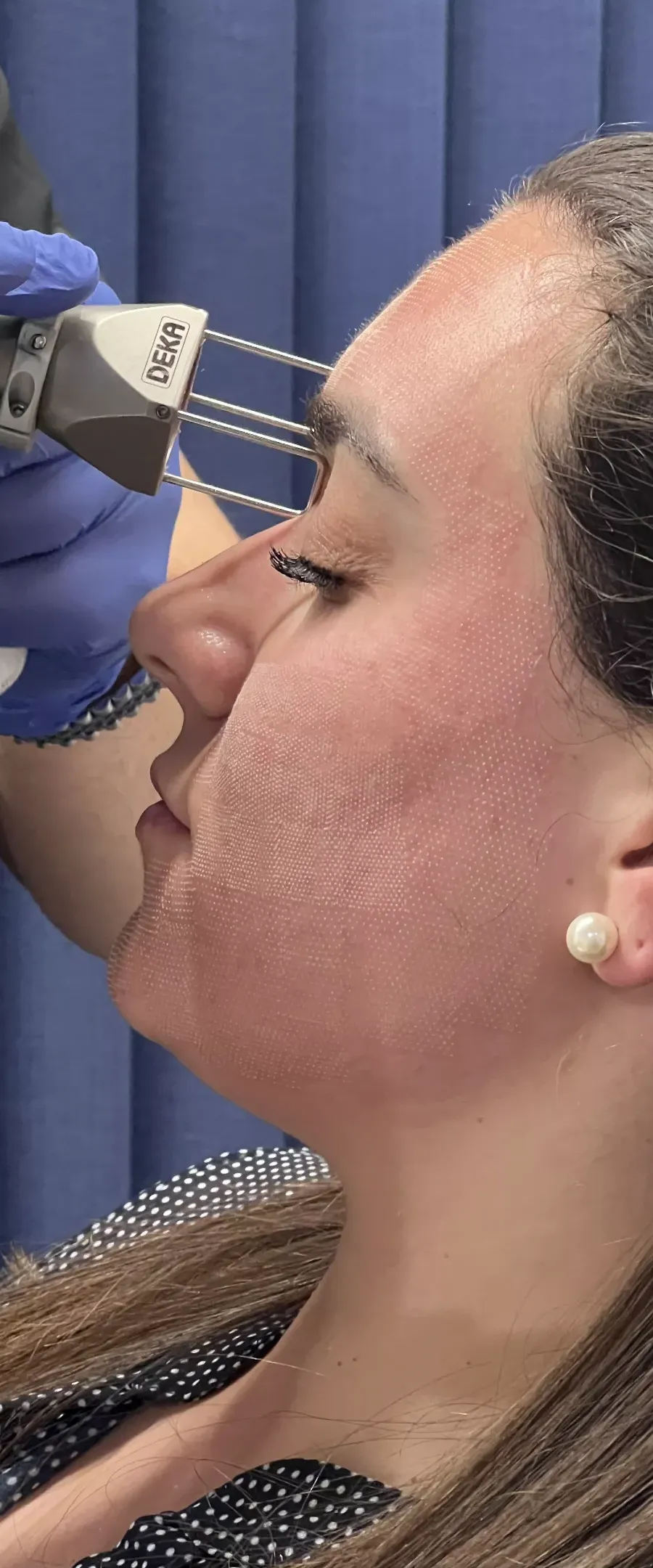 Εφαρμογή Fractional Laser στο πρόσωπο, με την επιδερμίδα να φέρει τα σημάδια της θεραπείας.